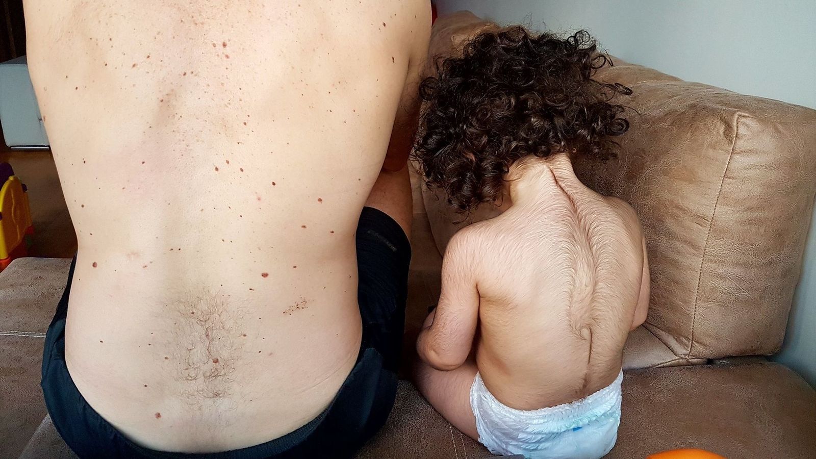 Bebé afectat d'excés de pèl corporal per haver ingerit fals omeprazole