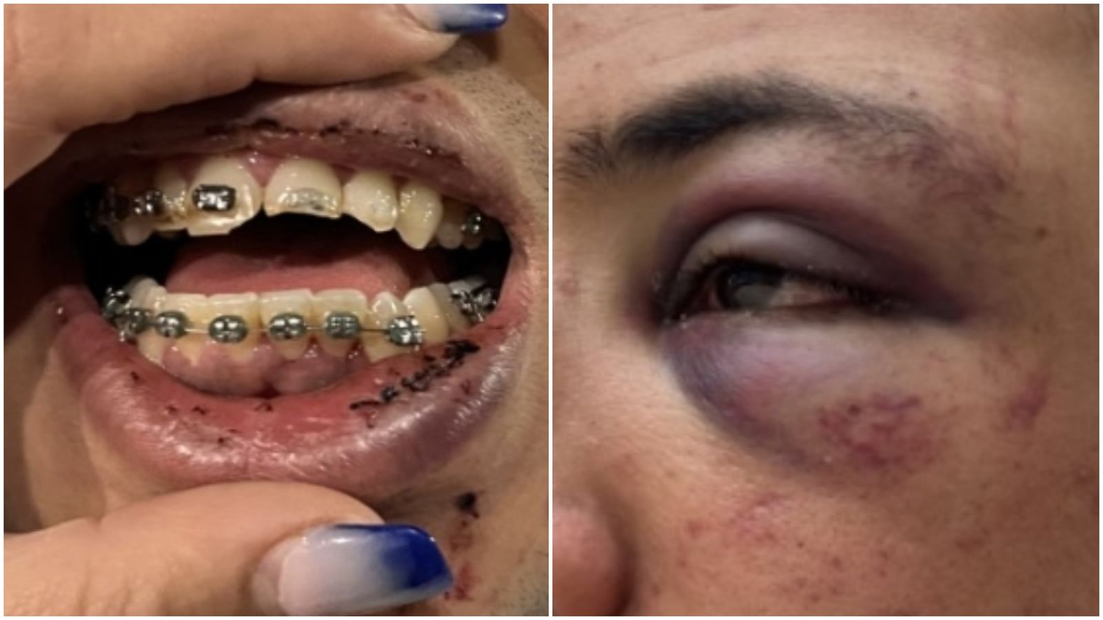 Detall de les dents trencades i l'hematoma a l'ull del denunciant
