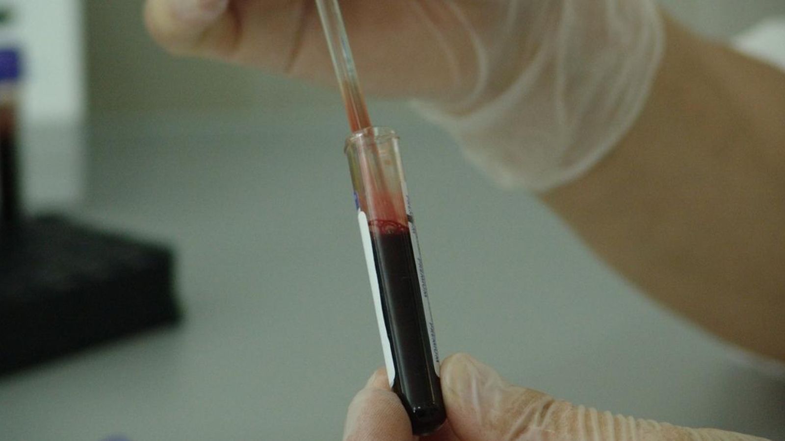 Confirmen la segona curació del món d'un pacient amb la sida