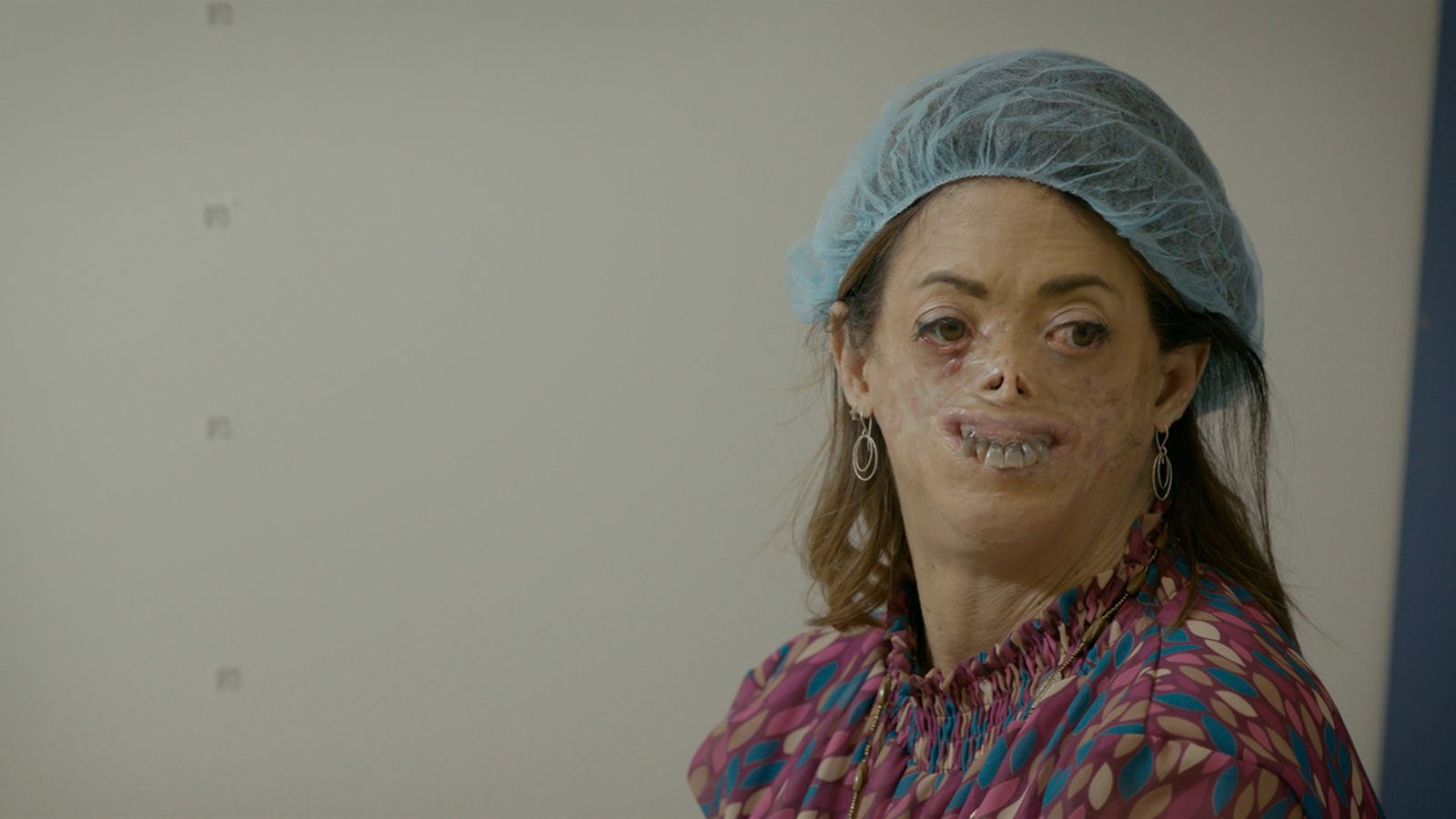 Fide Mirón, diagnosticada de porfíria de Günther, és una de les protagonistes de la docusèrie 'Crònica mèdica'