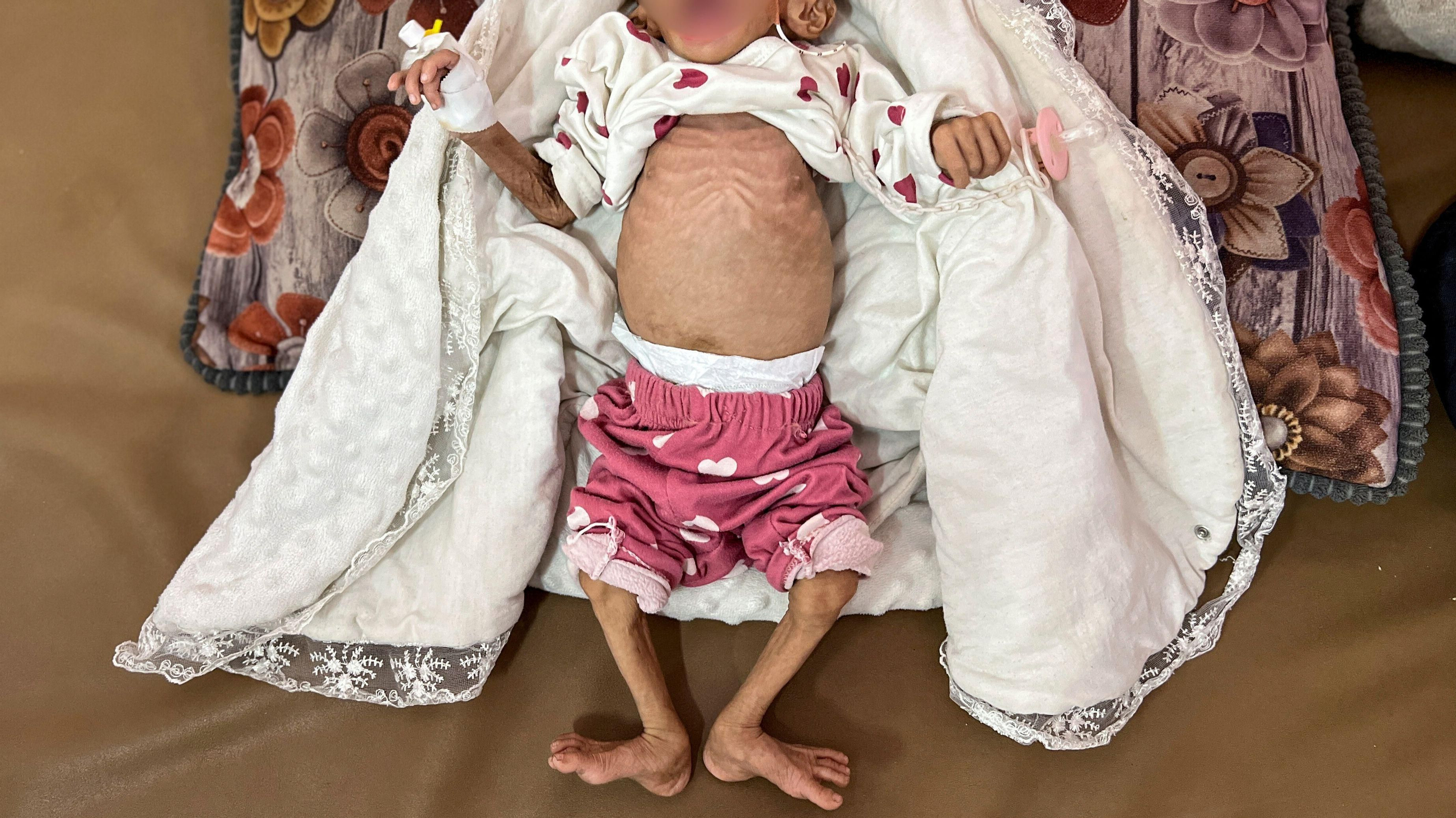 Zainab Abu Haleeb, una xiqueta de cinc anys de Gaza diagnosticada amb malnutrició En imatge, Zainab Abu Haleeb, una xiqueta de cinc anys de Gaza diagnosticada amb malnutrició