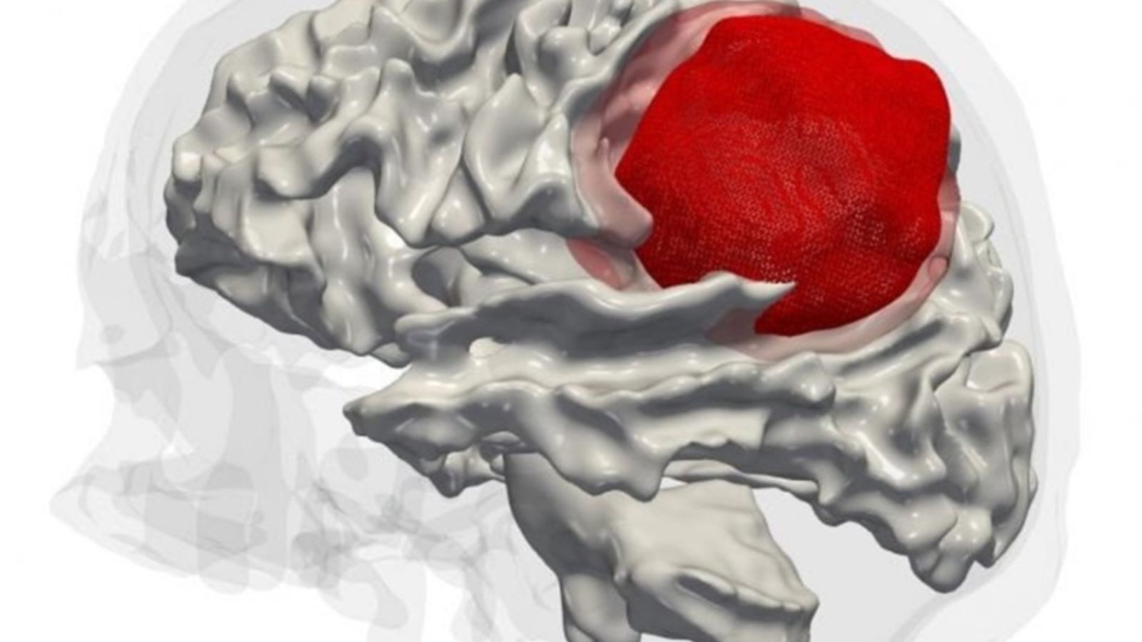 Glioblastoma, el càncer cerebral més agressiu