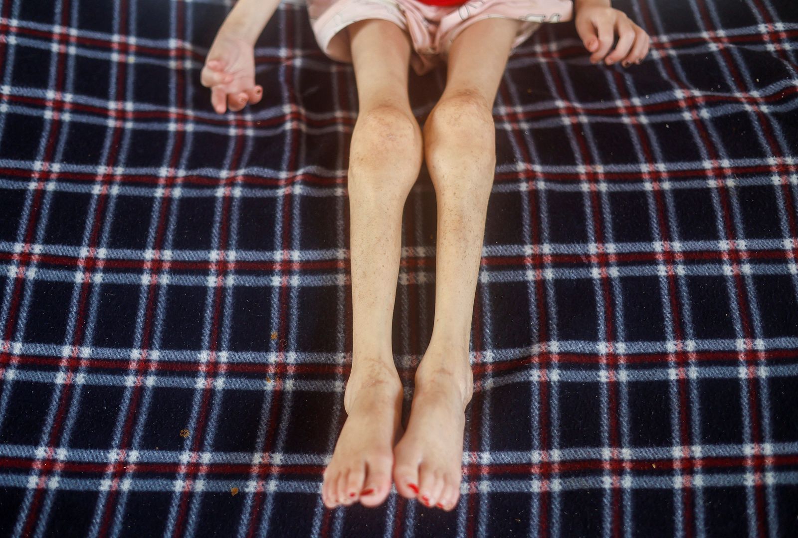 Evidències de desnutrició infantil en una menuda atesa a l'hospital de Deir Al-Balah