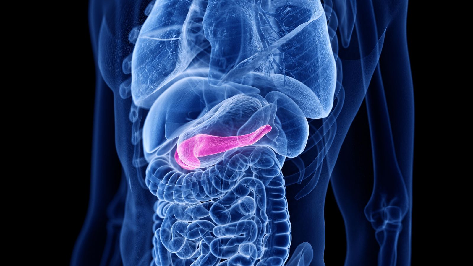 L'adenocarcinoma ductal pancreàtic, que suposa la tercera causa de mort per càncer en països desenvolupats