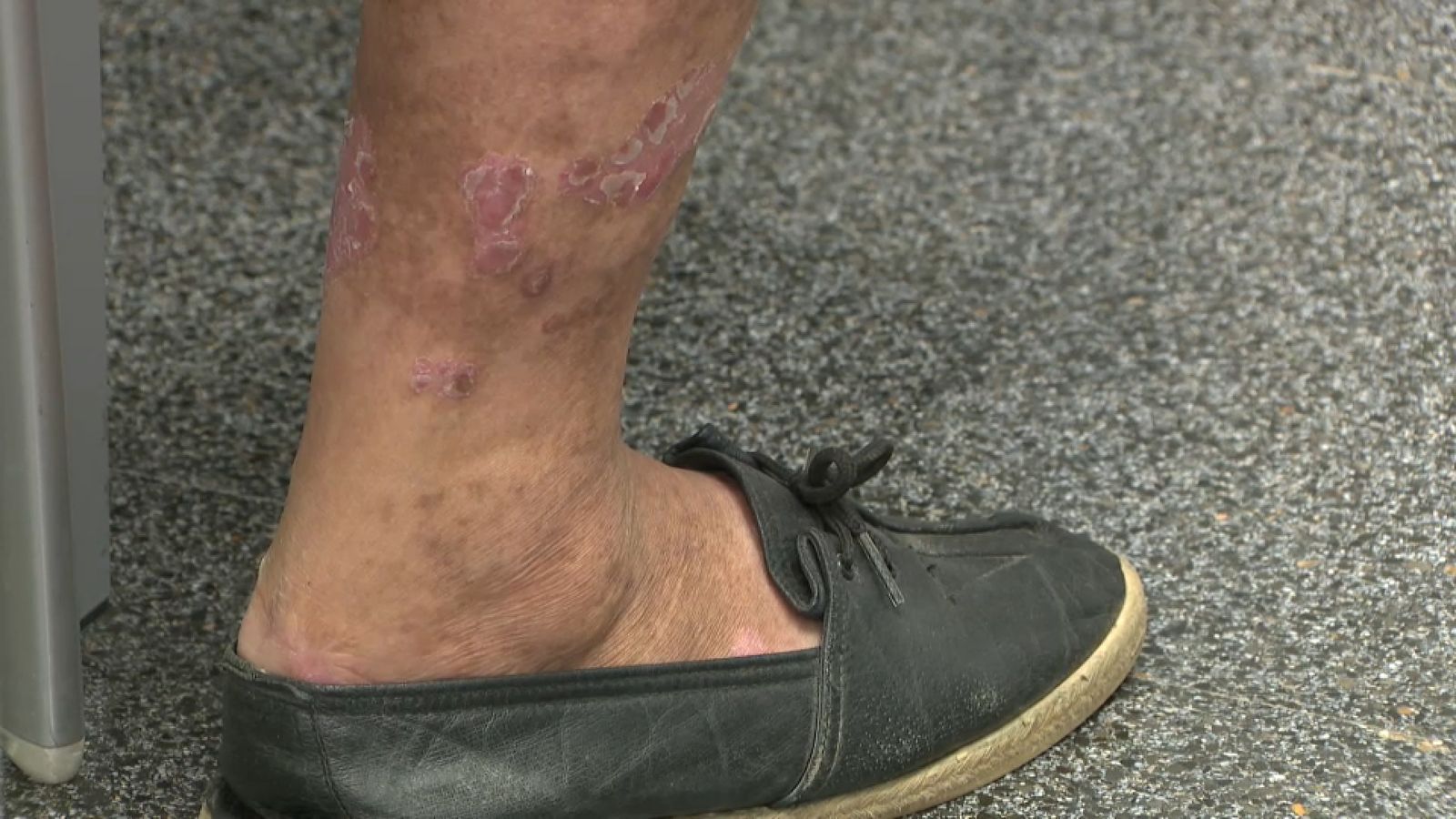 Un home afectat per la ronya