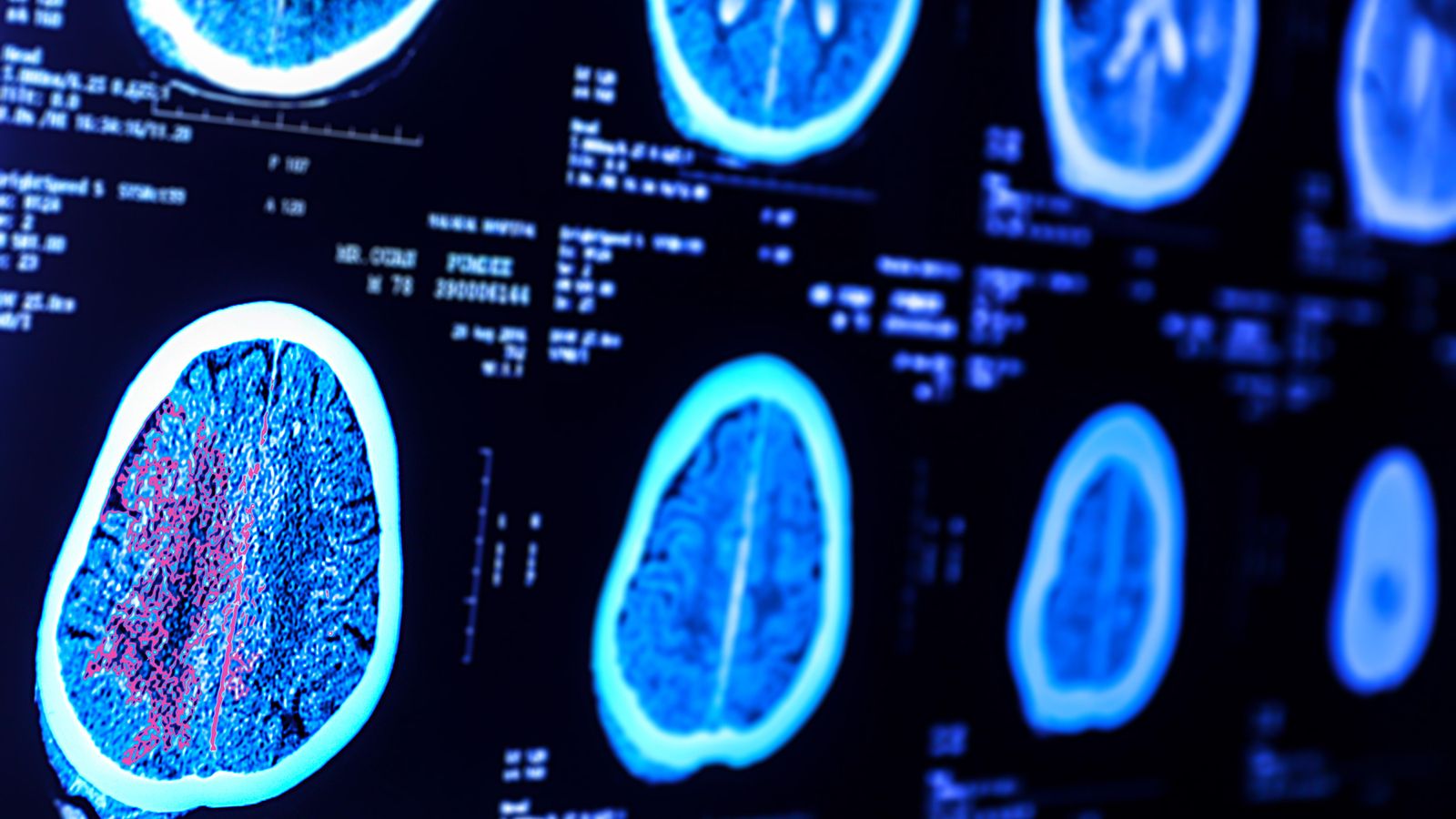 Resonància magnètica d'un cervell