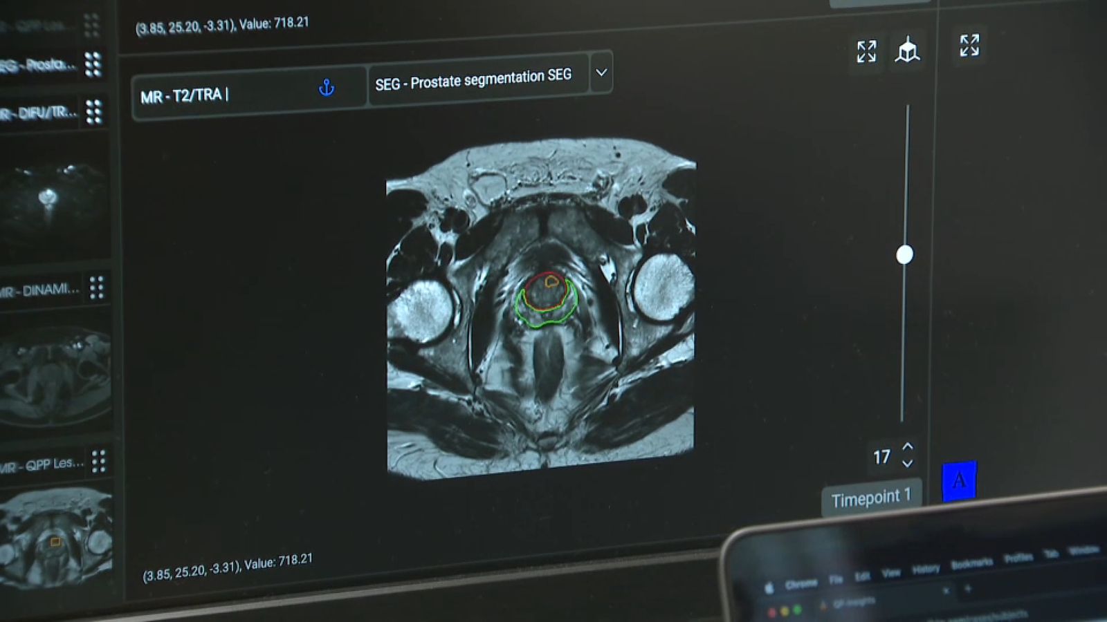 Intel·ligència artifical per a millorar el diagnòstic de càncer