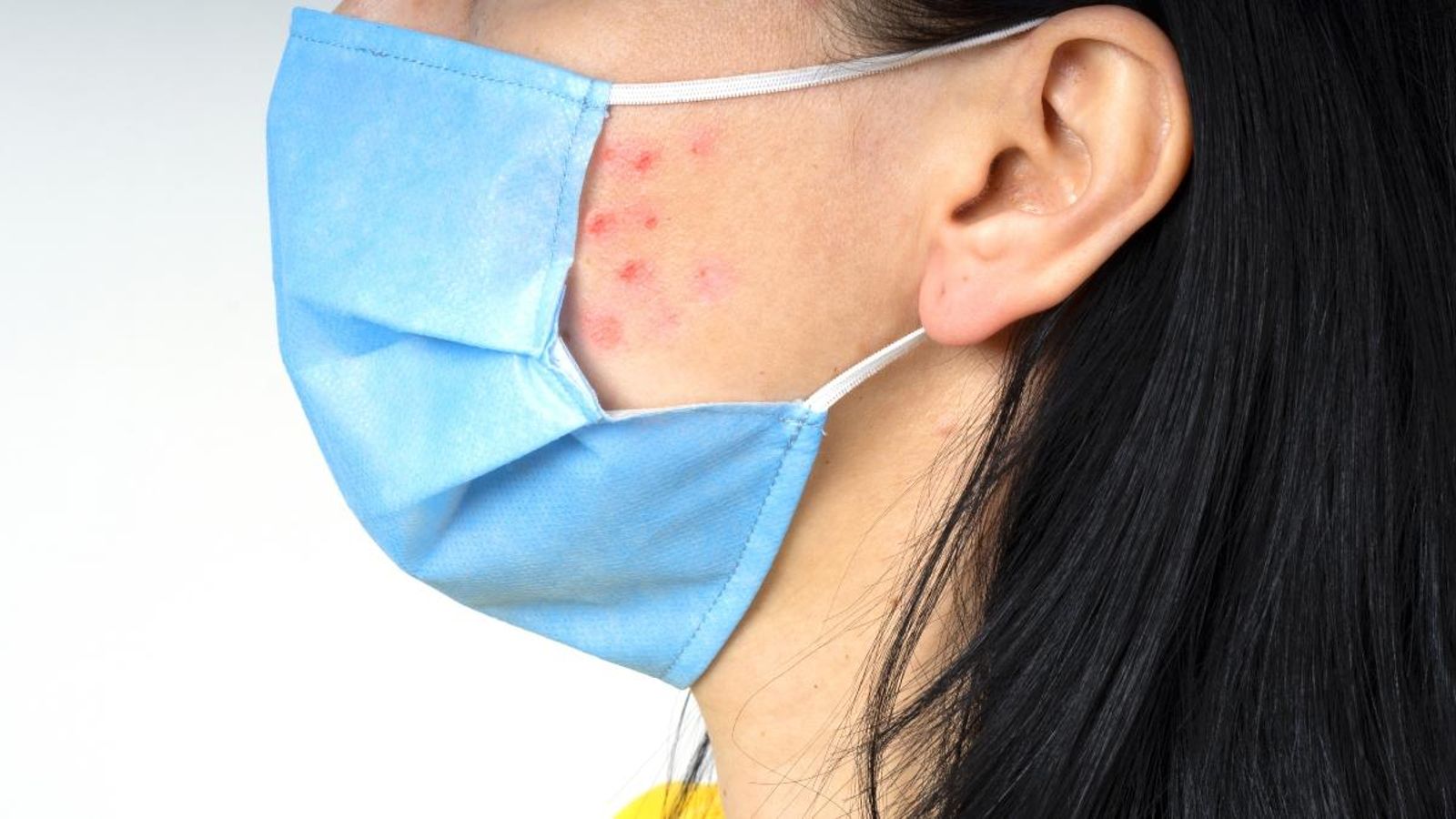 L'acne, una de les patologies agreujades per l'ús de mascareta.