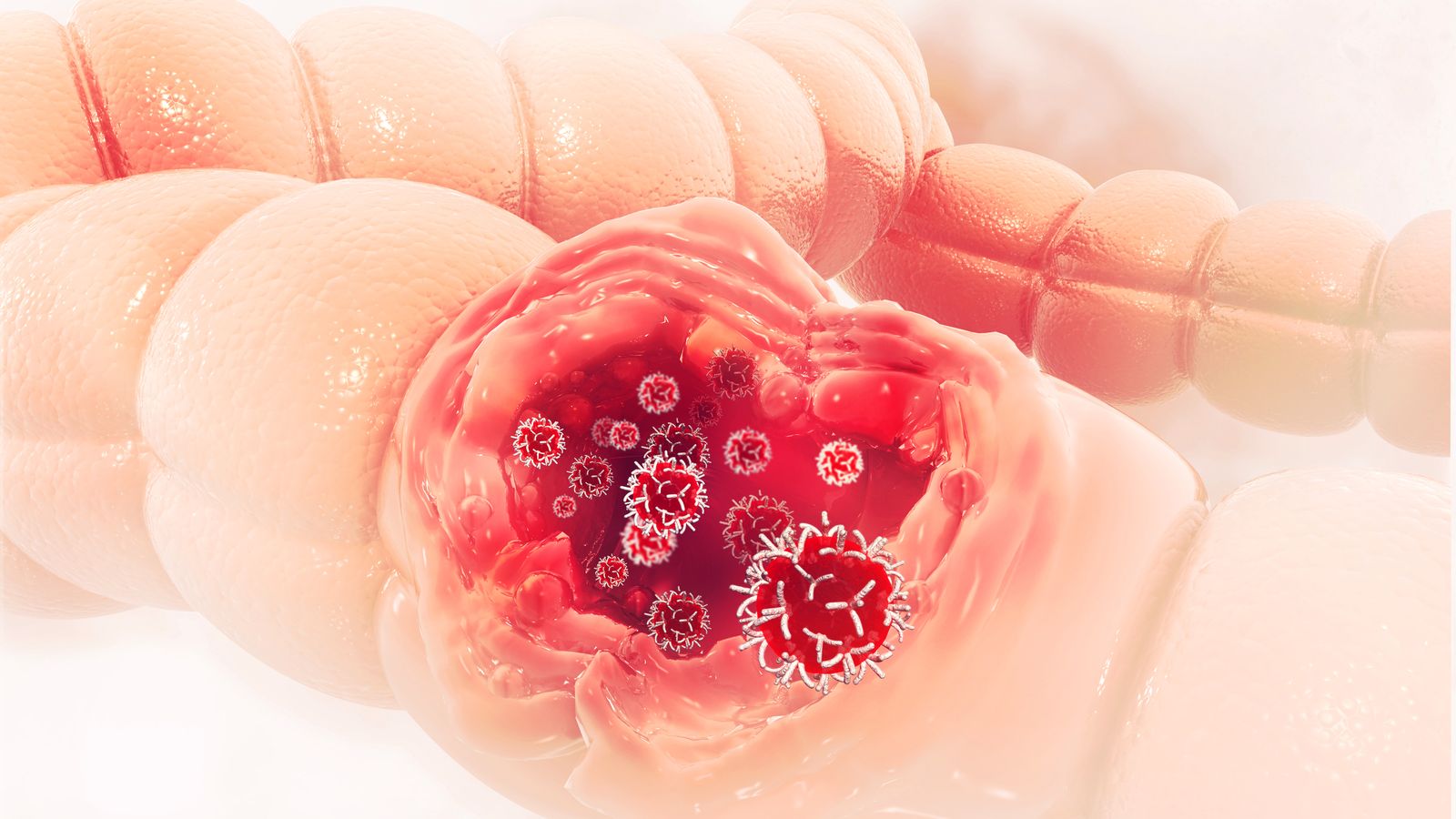Recreació en 3D del procés d'atac de les cel·lules cancerígenes al colon