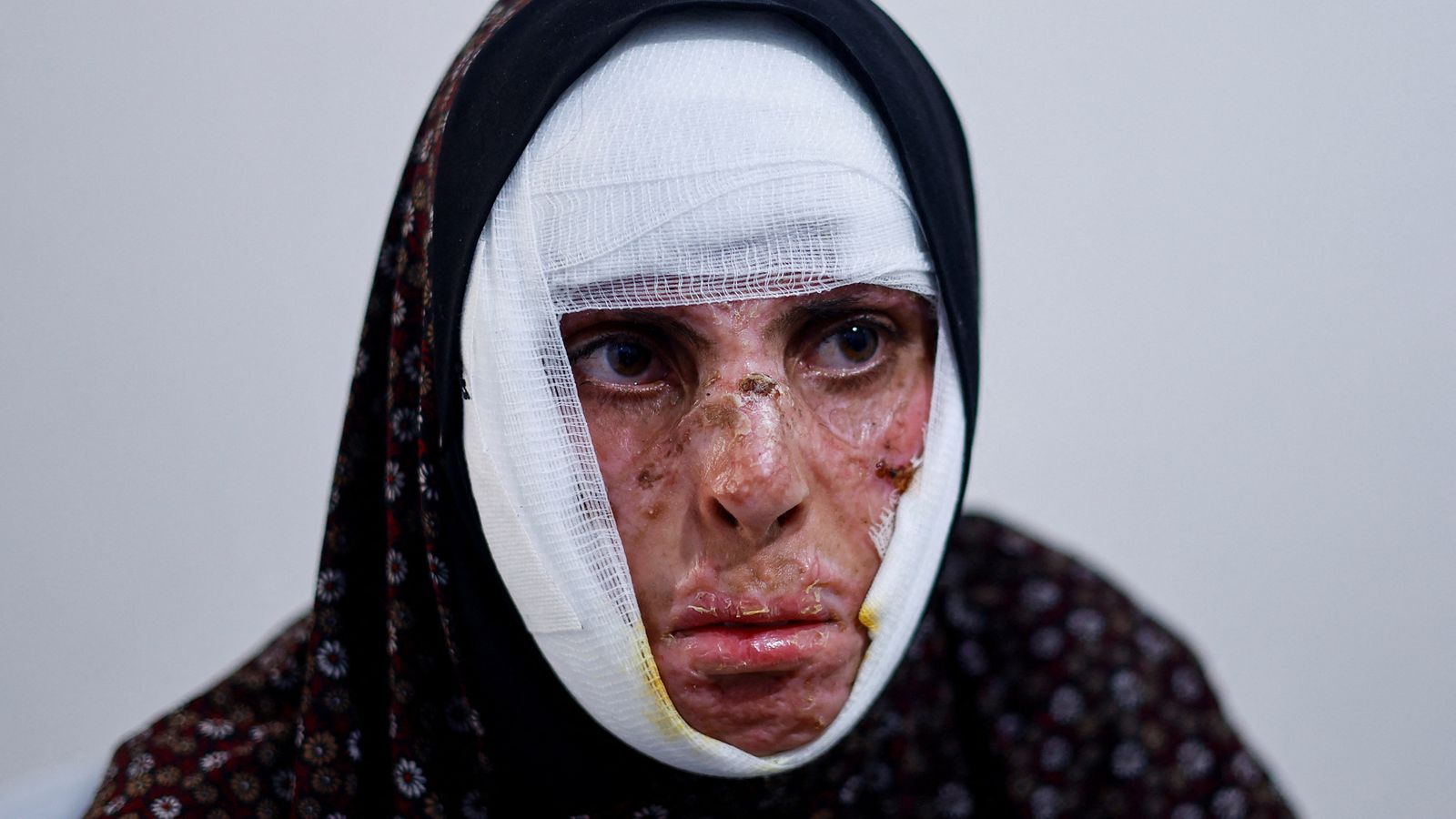 La palestina Shaima Qarmout, cremada en un atac israelià, rep assistència de Metges Sense Fronteres a un hospital de Rafah