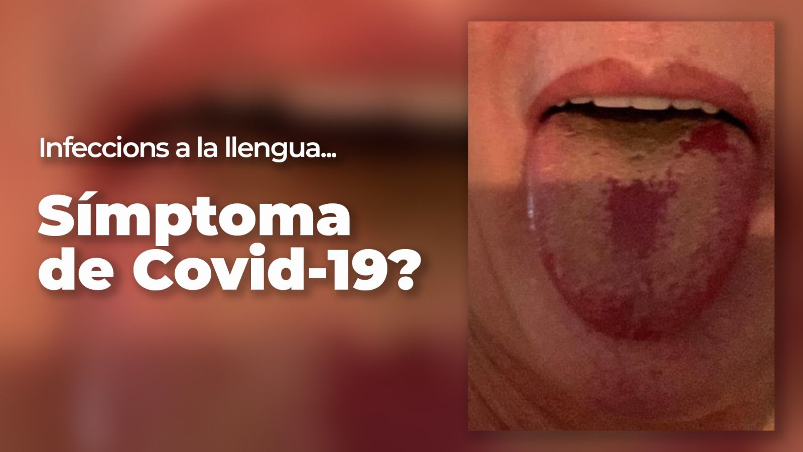 La ‘llengua Covid’, un nou símptoma del coronavirus?