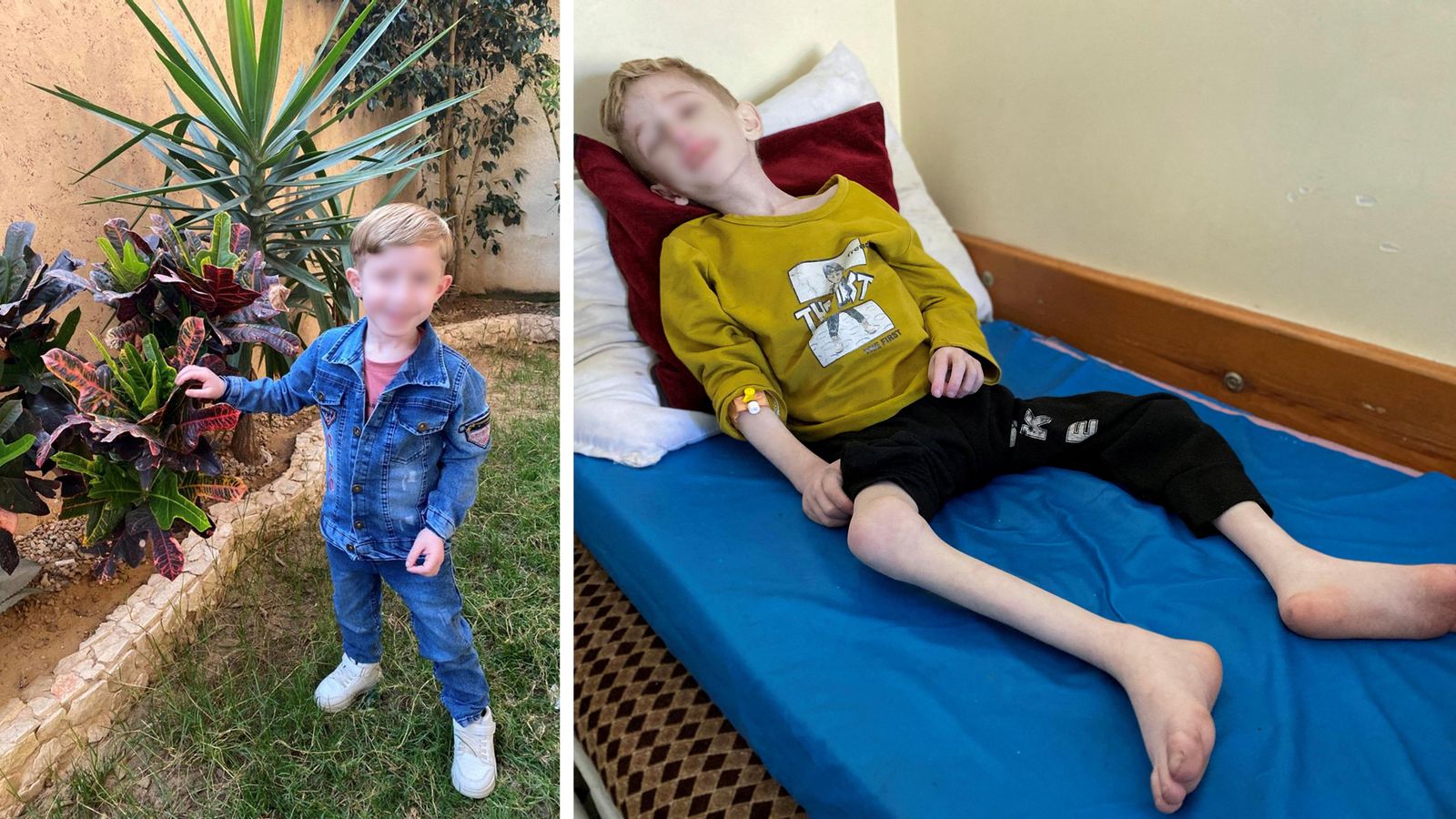 L'abans i el després del xiquet palestí Fadi al-Zant, ingressat per malnutrició severa a l'hospital Kamal Adwan