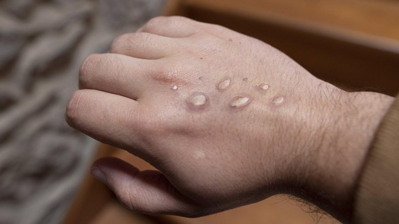 Erupció provocada per una infecció de pigota dels micos