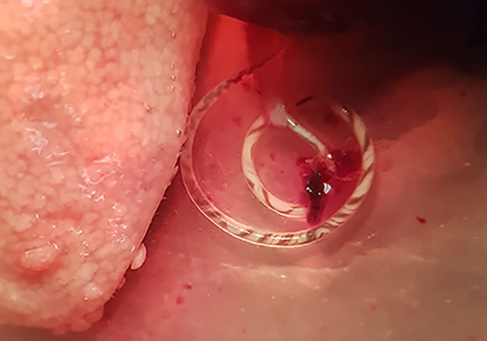 Cuc pulmonar de la rata emergint de l'artèria pulmonar d'una rata capturada en zona d'horta de València