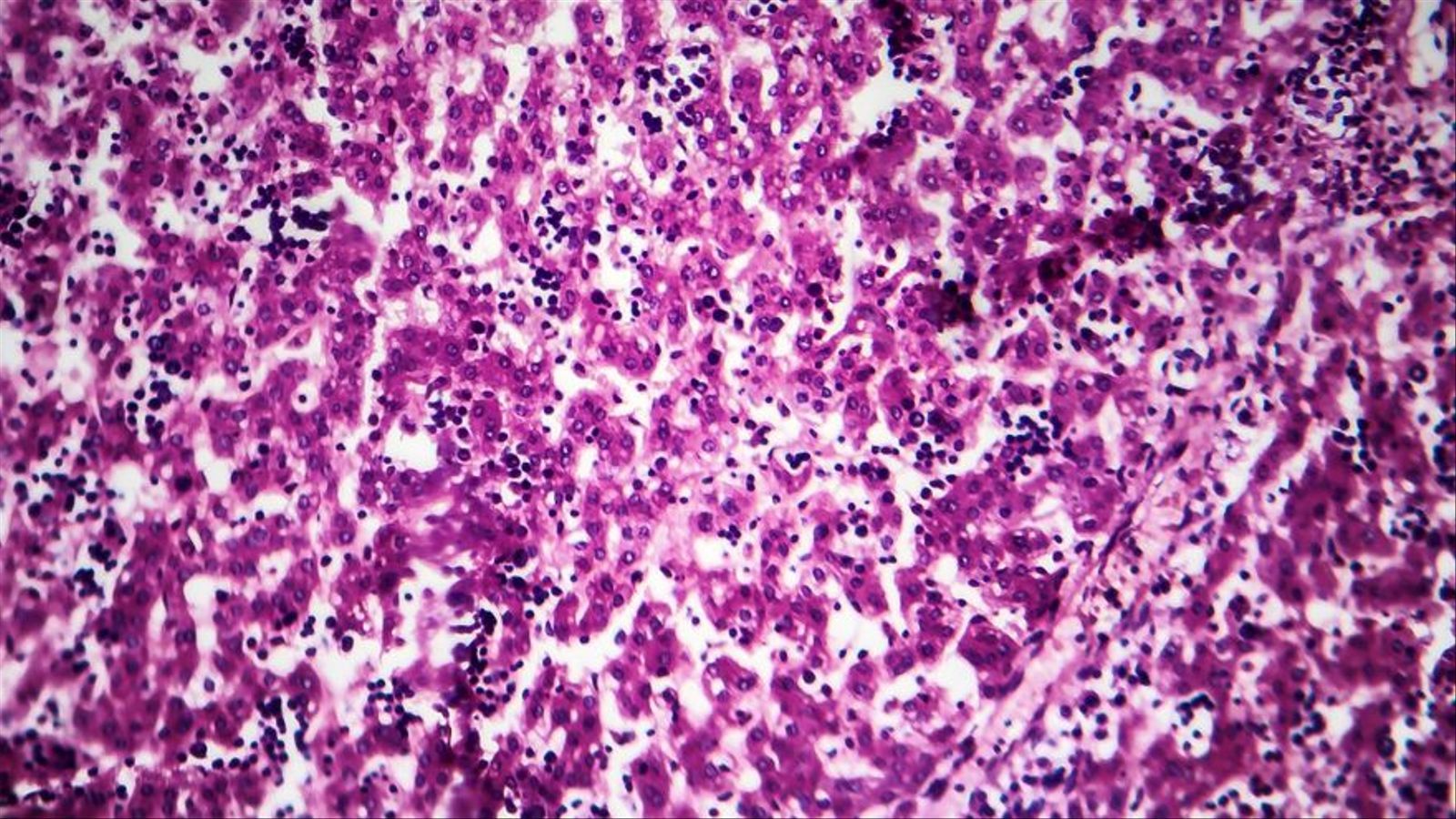 Histopatologia de l'hepatitis crònica activa, fotografia al microscopi