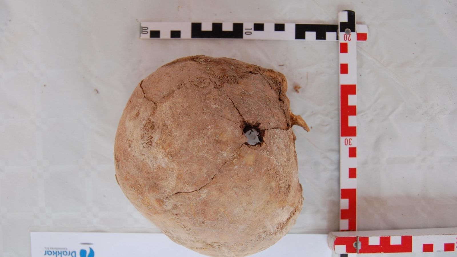 Orifici d'eixida de bala en un crani exhumat