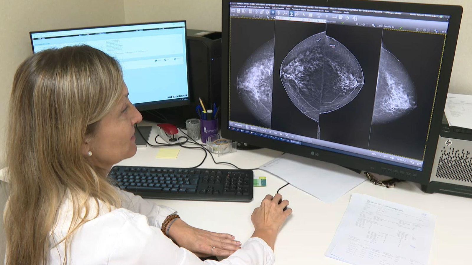 La prevenció i les revisions periòdiques són clau en la prevenció del càncer de pit