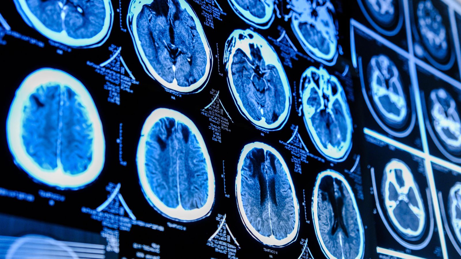 Ressonància magnètica d'un cervell