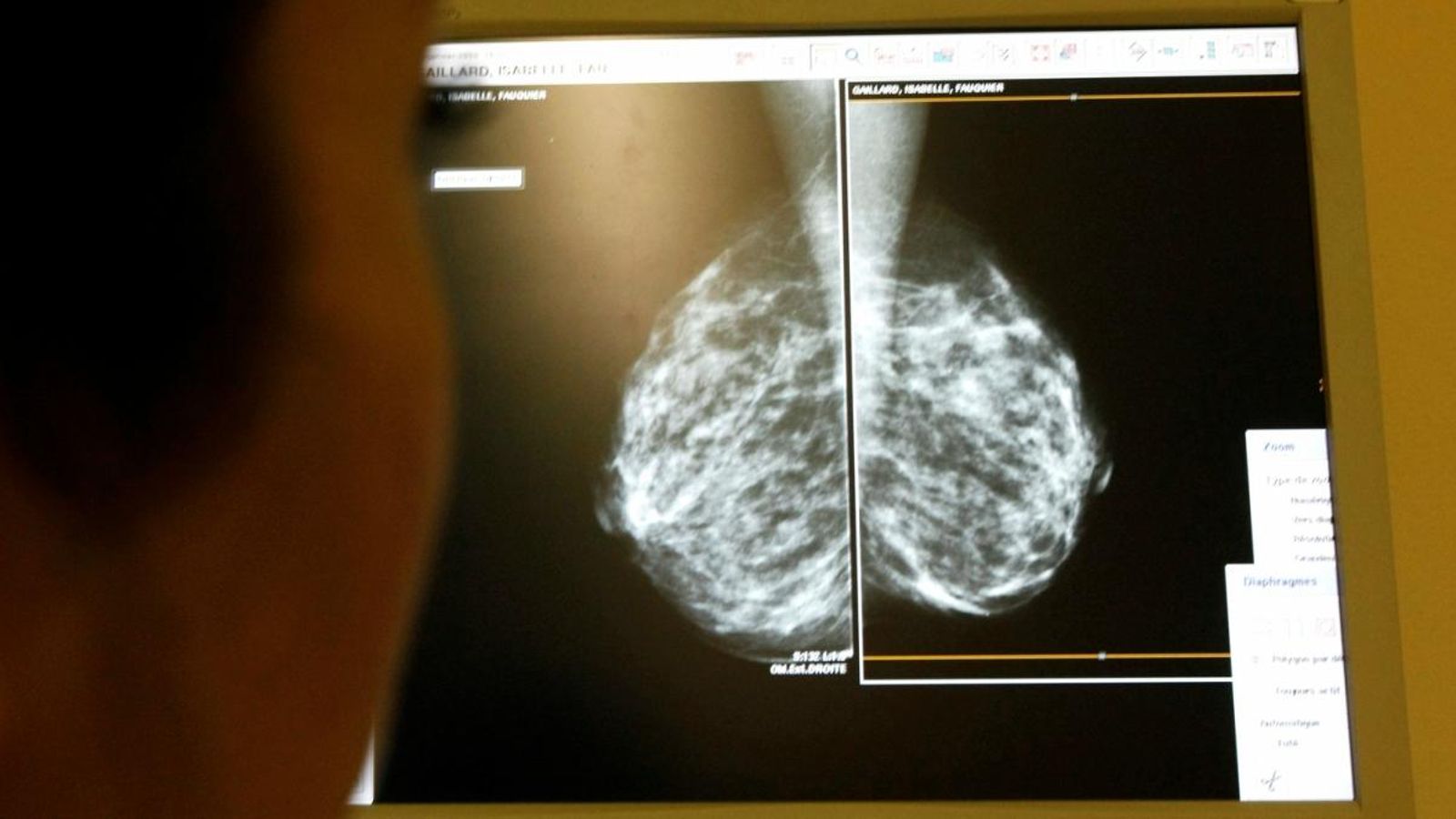 Un radiòleg analitza i compara dues mamografies per tal de detectar tumors mamaris