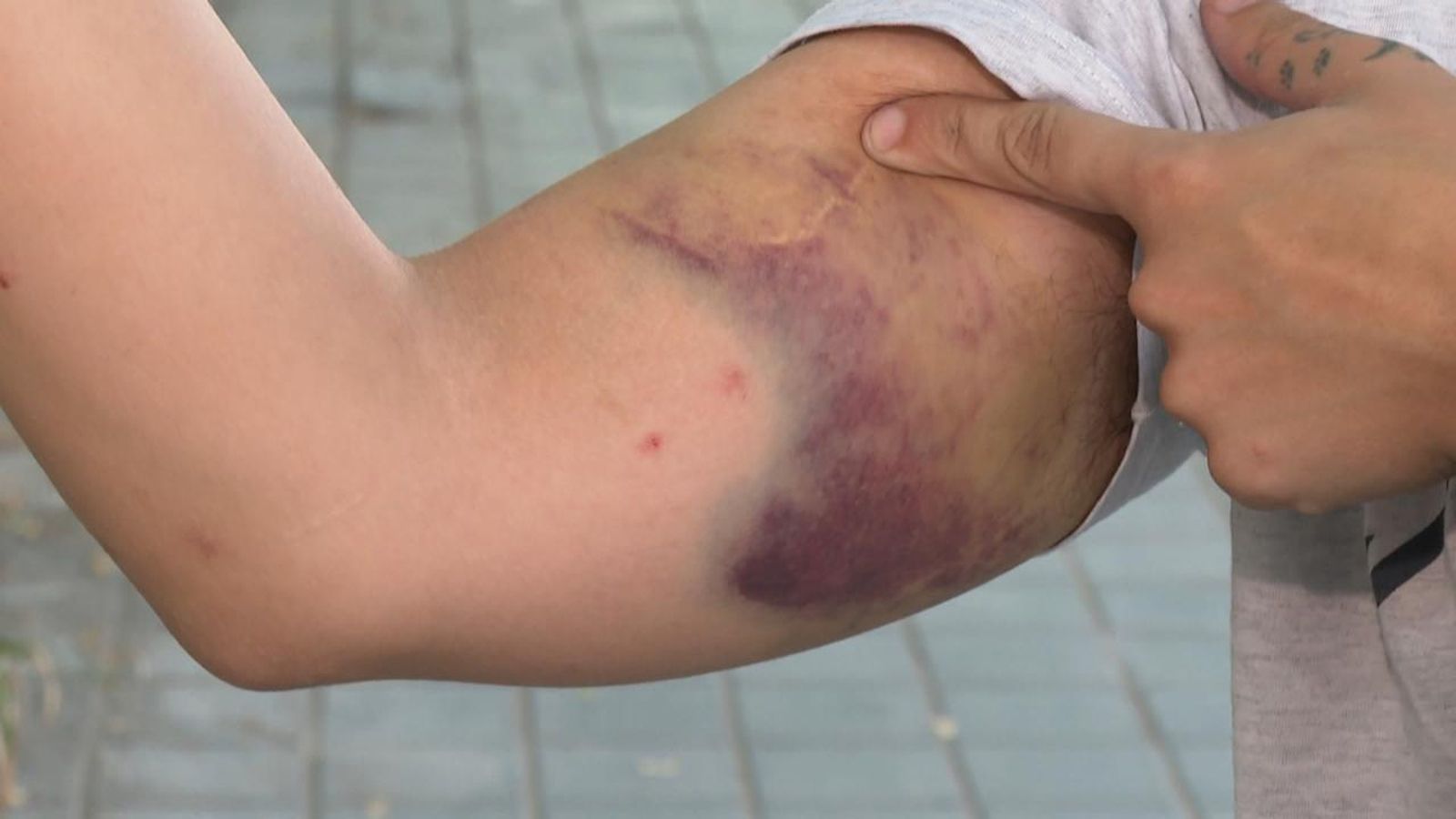 El xic agredit mostra les ferides de l'agressió homòfoba