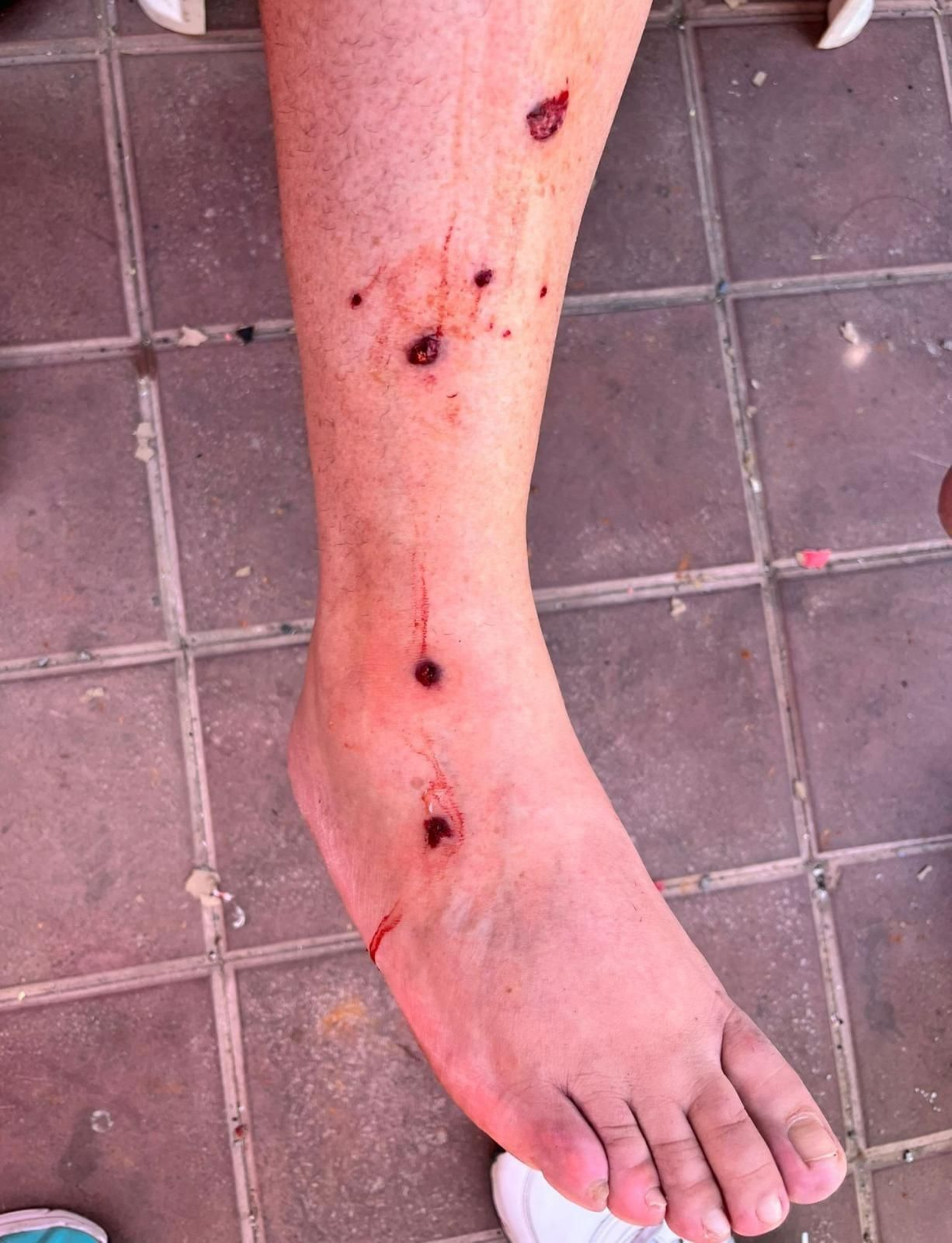 Detall de la cama d'una de les persones ferides per impacte de la metralla de la carcassa