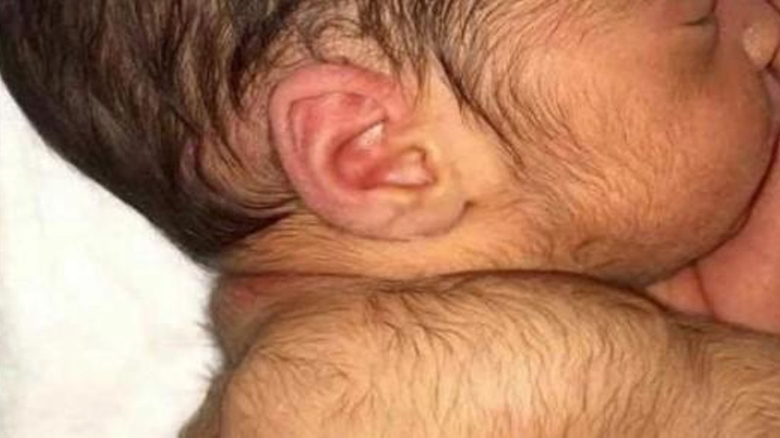 Imatge d'un bebé amb hipertricosis en una imatge d'arxiu