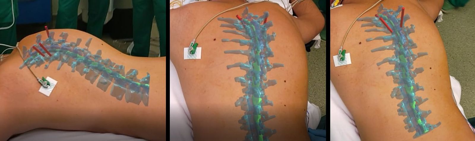 Reconstrucció tridimensional de la columna vertebral en un pacient
