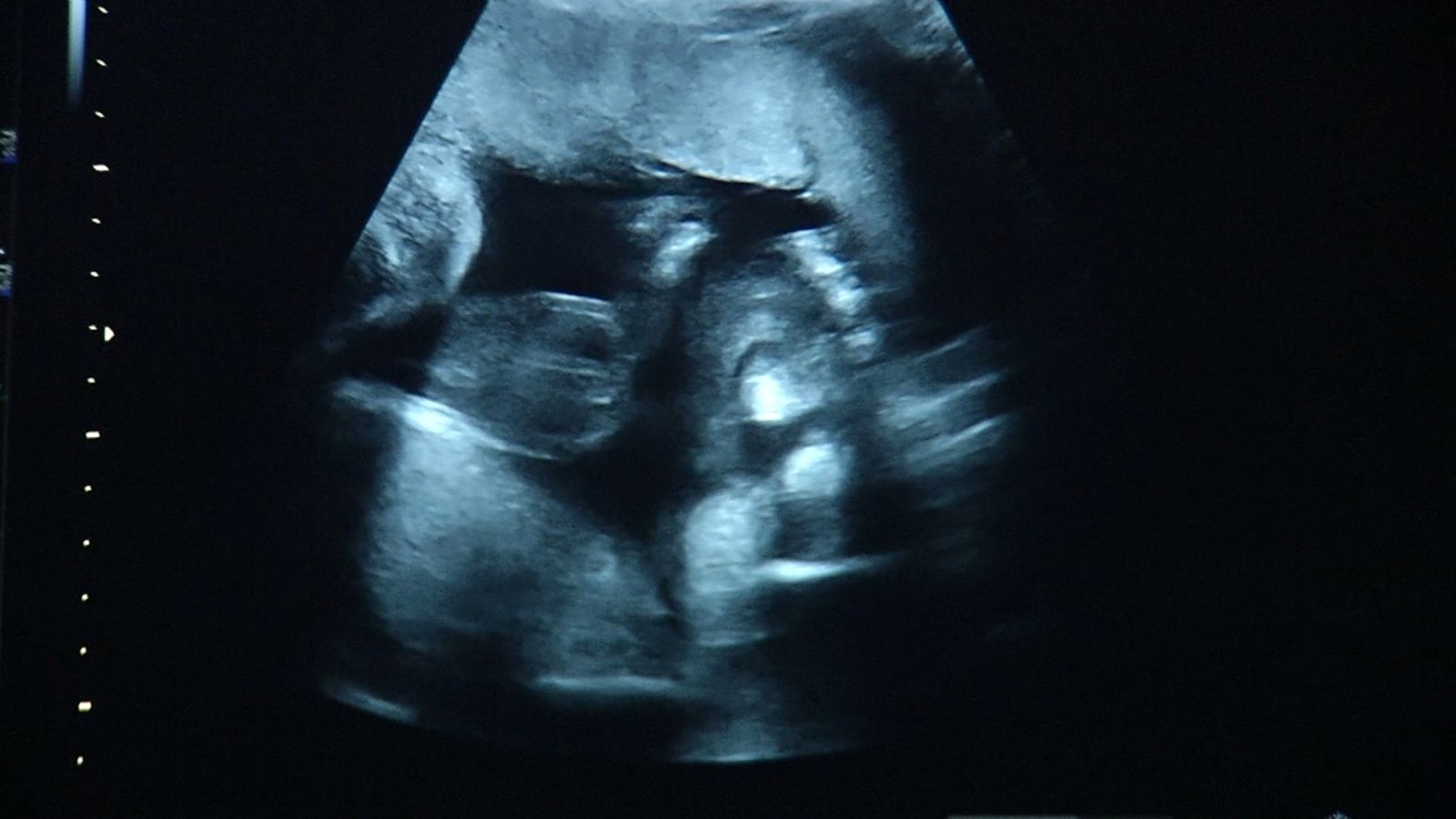 Les llistes d'espera per a la fecundació 'in vitro' superen els dotze mesos. Foto de portada: una ecografia