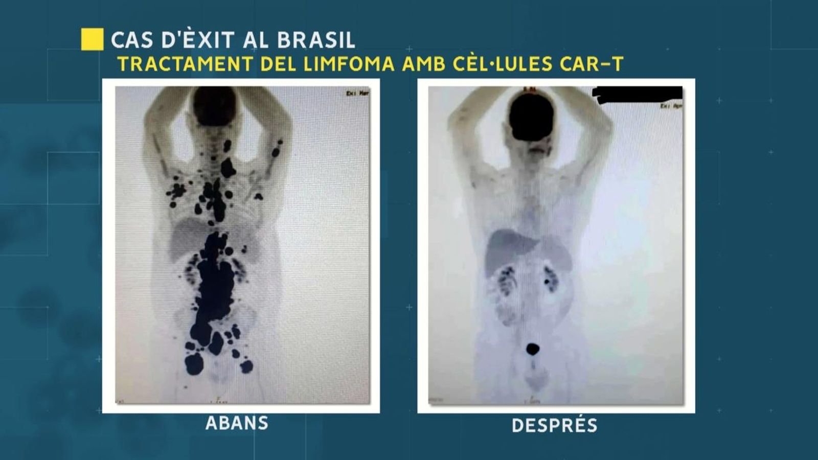 Evolució del càncer d'un home al brasil després de rebre la teràpia amb cèl·lules Car-T