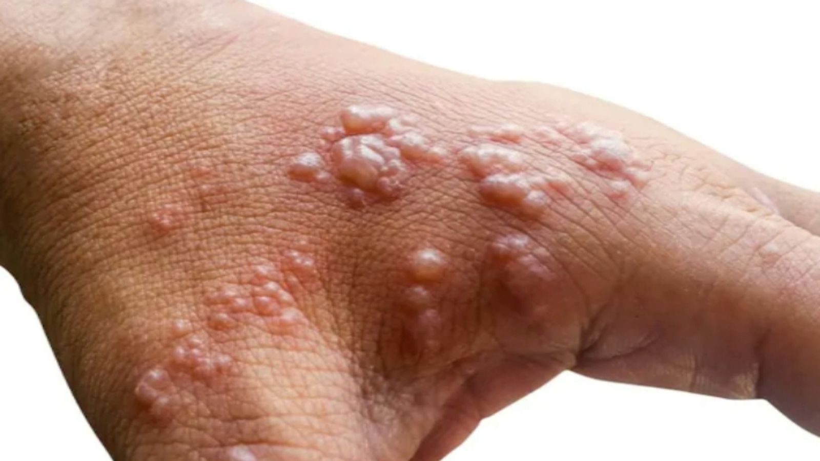 La pigota dels micos comença a estendre's per tot Espanya