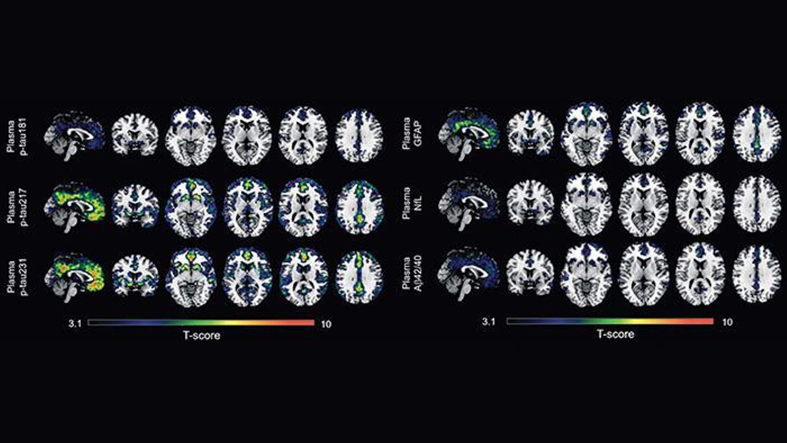 Identifiquen dos biomarcadors per al diagnòstic precoç de l'alzheimer
