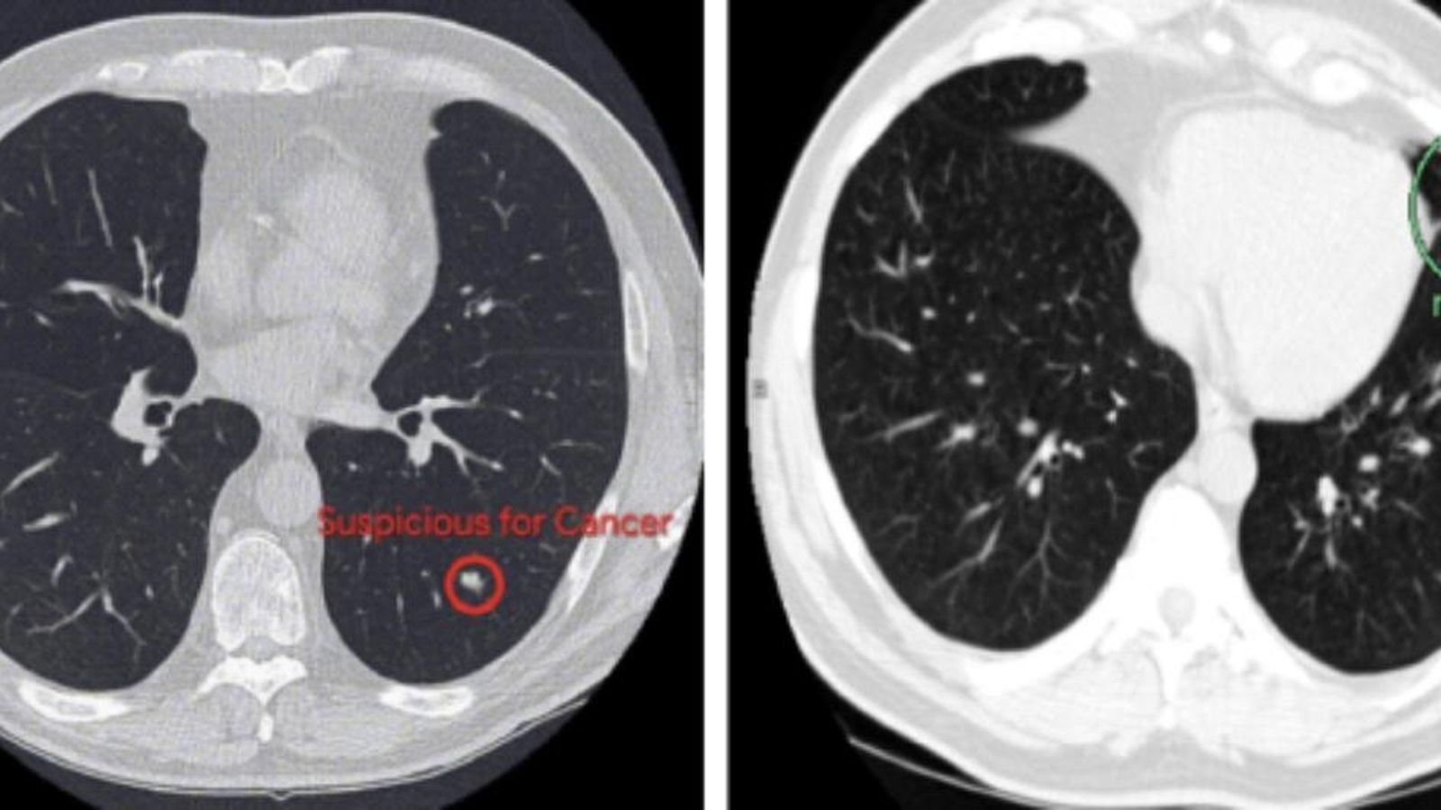 Científics estatunidencs han desenvolupat un sistema d'intel·ligència artificial capaç de detectar càncer de pulmó