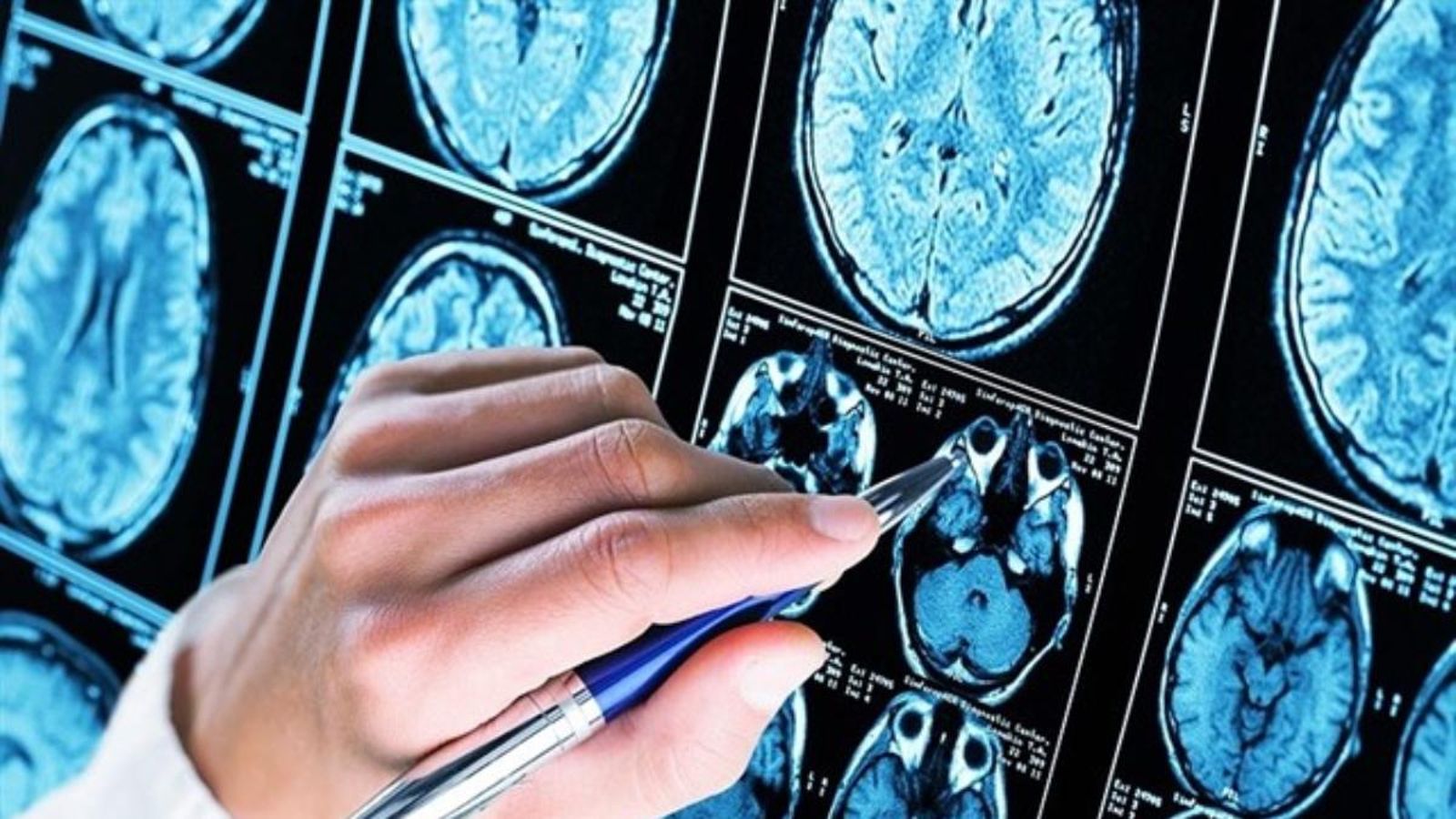 Sanitat diagnostica 4.000 nous casos d\'Alzheimer a la Comunitat Valenciana en 2019