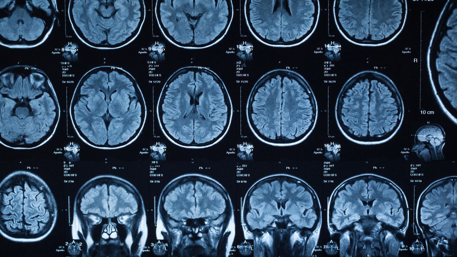 L'assaig clínic APRIL en fase I ha testat el fàrmac ApTOLL sobre una mostra de 151 pacients