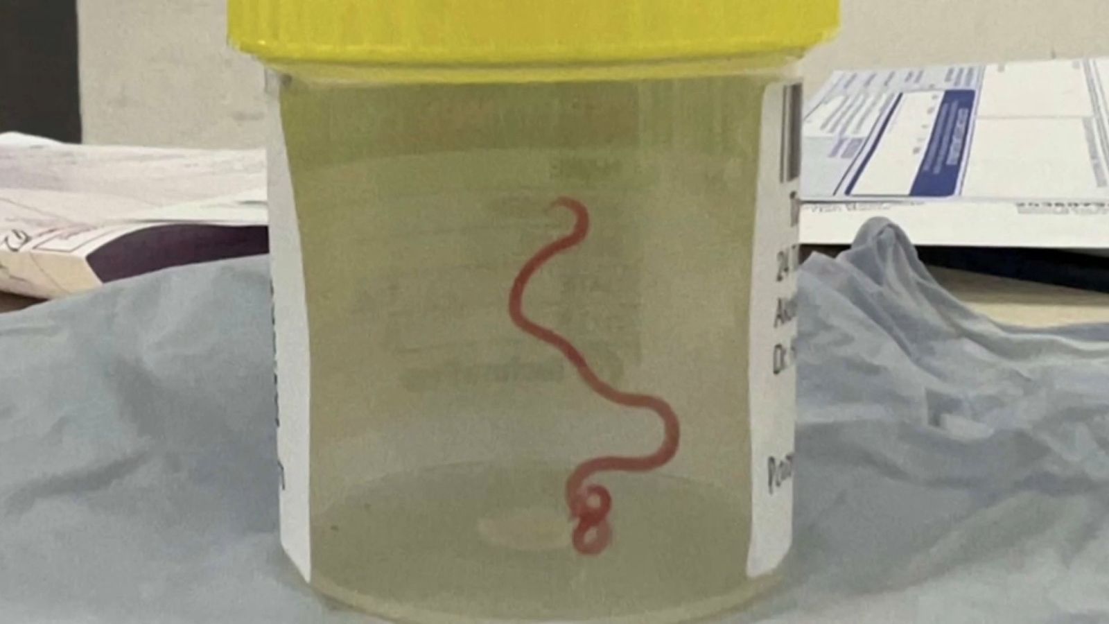 Imatge del cuc trobat en el cervell de la dona, ja guardat en un contenidor