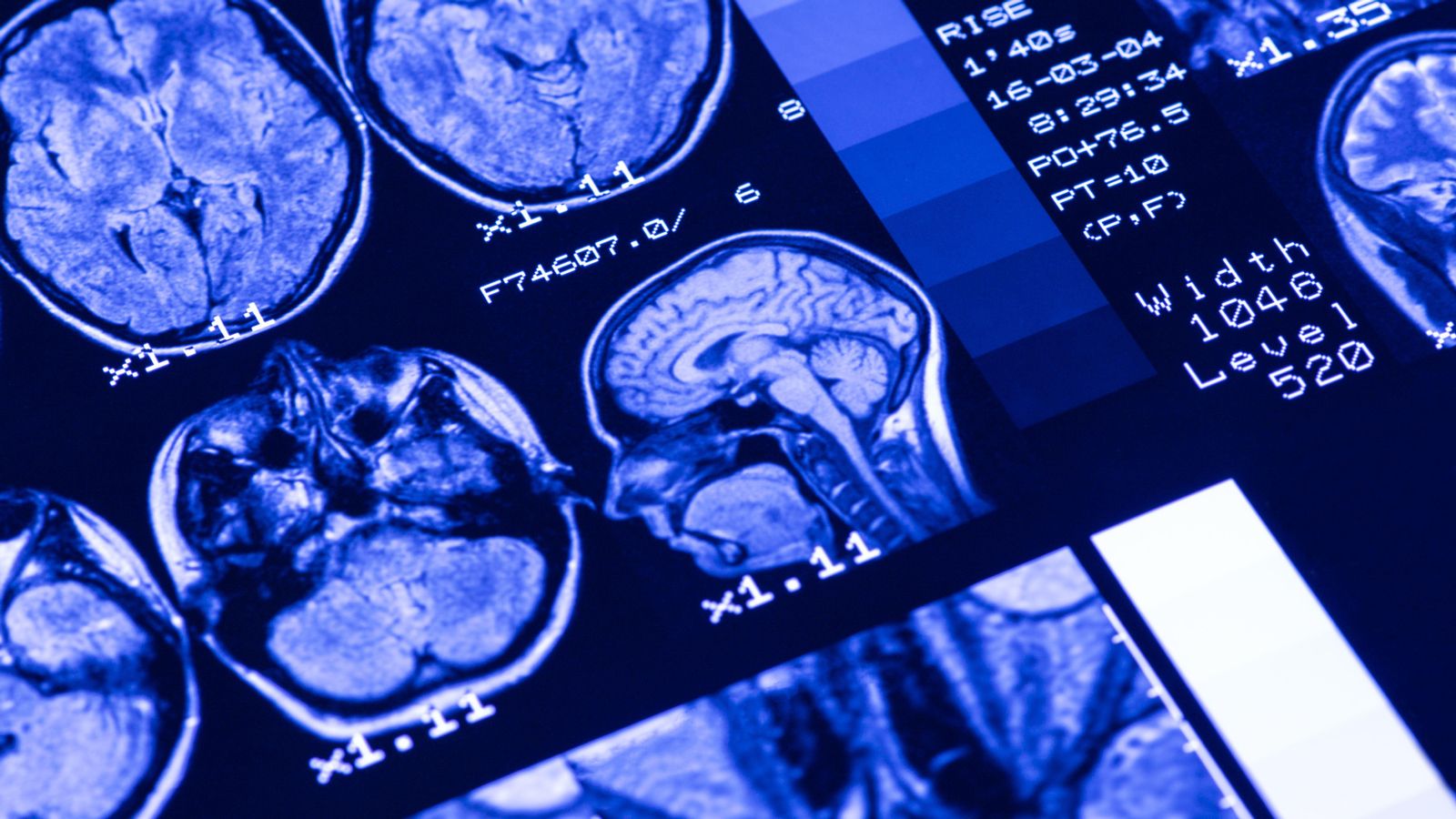 Imatge d'arxiu d'una resonància del cervell