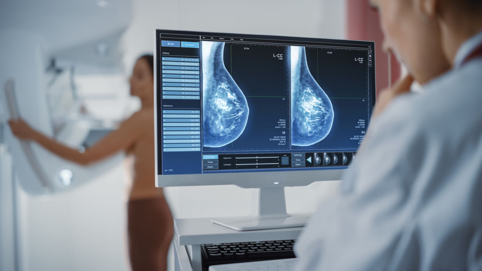 Es convidarà a 10.000 dones, 4.000 d'elles diagnosticades amb càncer de mama i 6.000 sanes, de tota Espanya