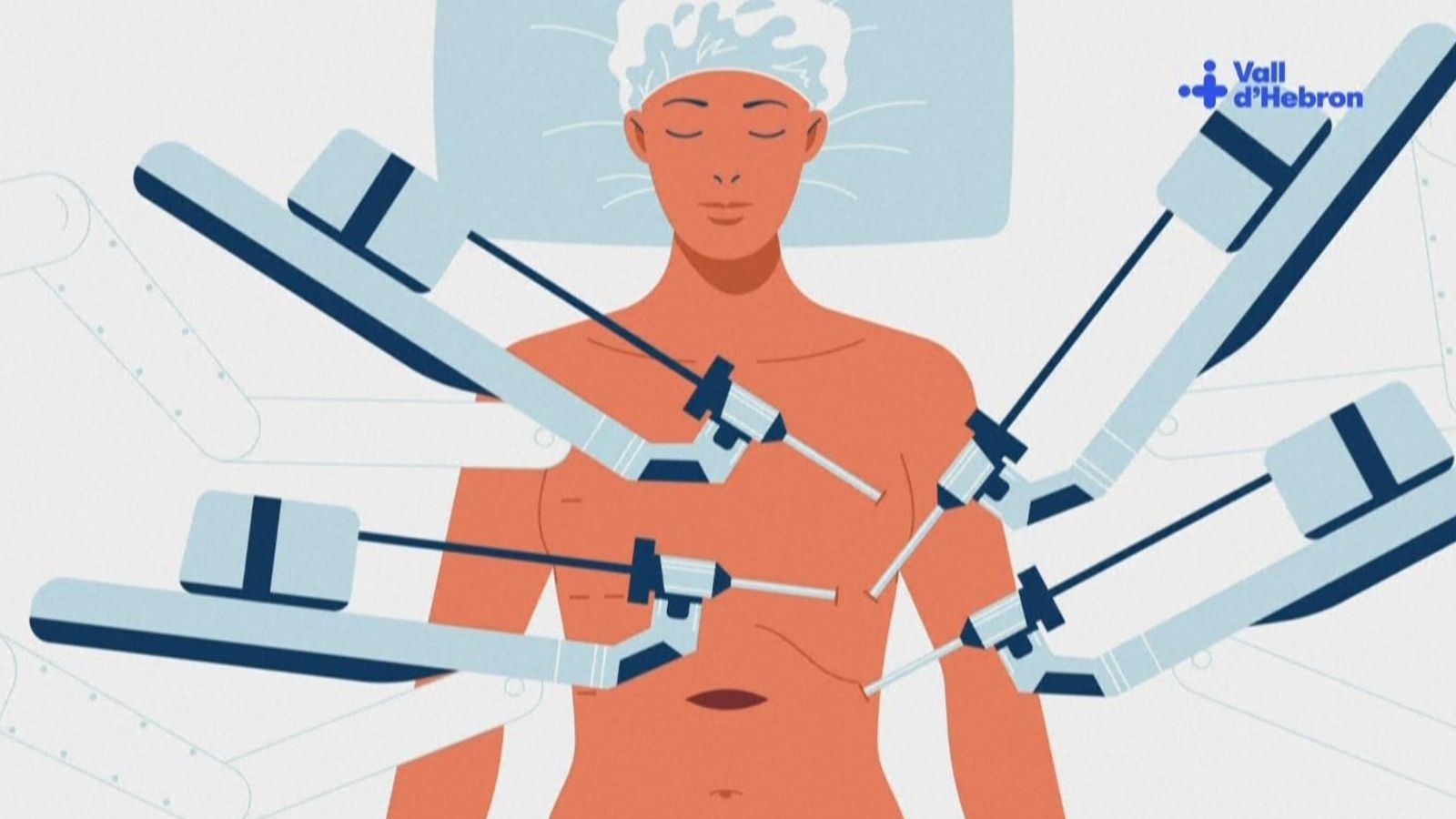 El trasplantament de pulmó s'ha fet per xicotetes incisions de pocs centímetres