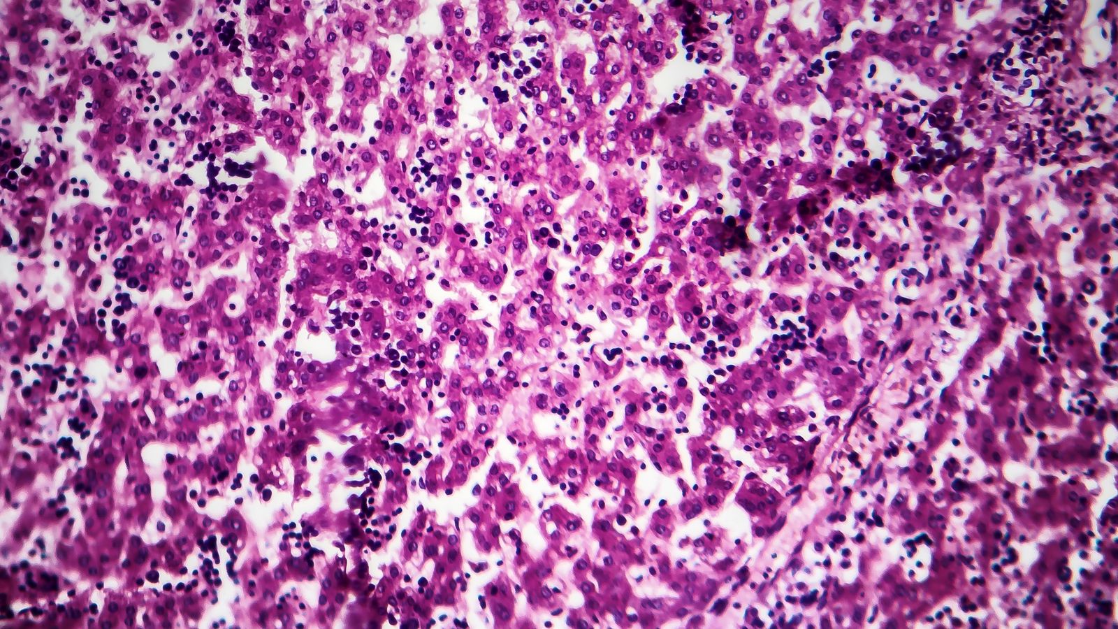 Histopatologia de l'hepatitis crònica activa, fotografia al microscopi
