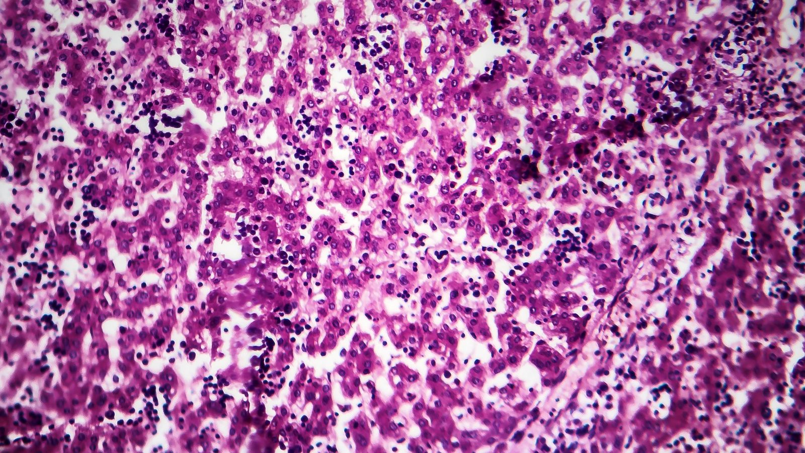 Histopatologia de l'hepatitis crònica activa, fotografia al microscopi Histopatologia de l'hepatitis crònica activa, fotografia al microscopi