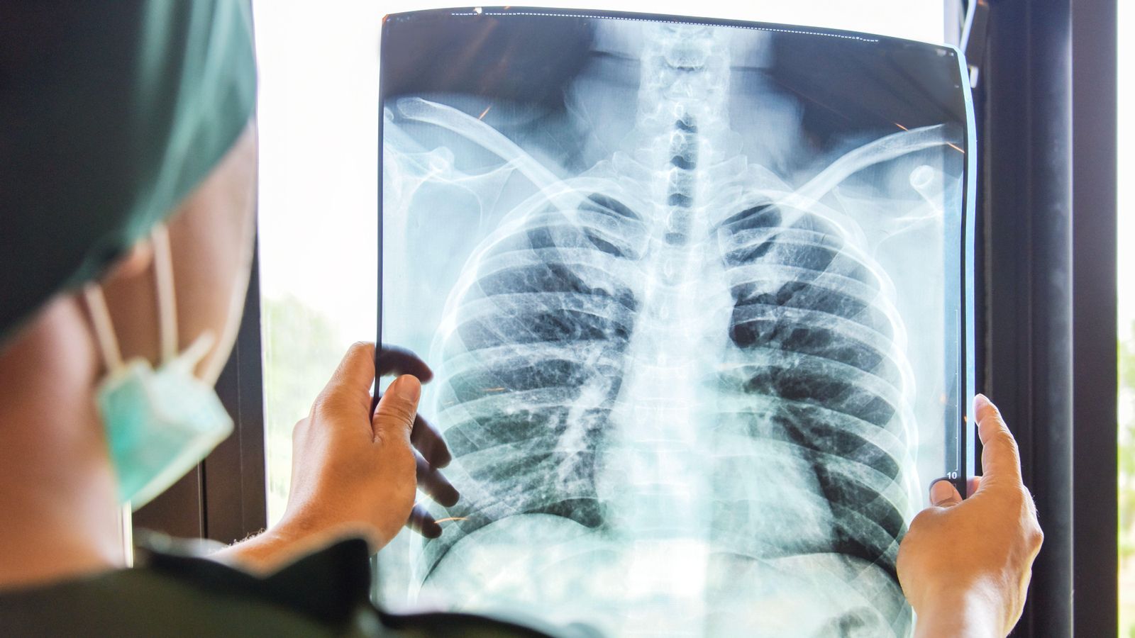 El càncer de pulmó de cèl·lules no xicotetes és la principal causa de mortalitat per càncer en el món