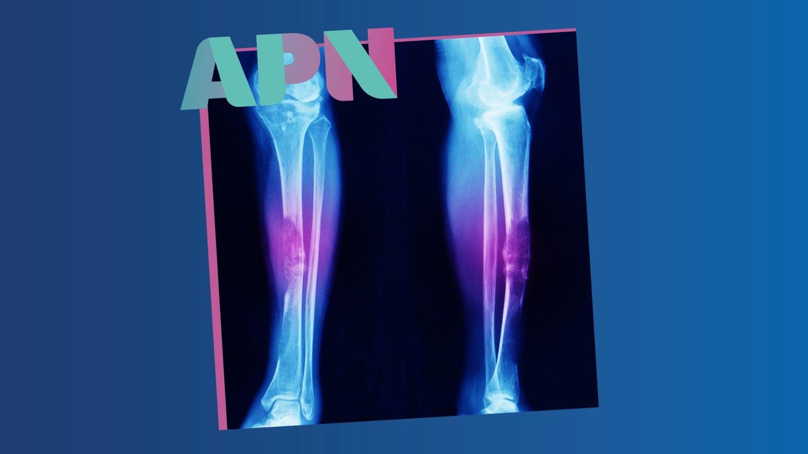 10.07.2025 | El sarcoma, un càncer poc conegut que cal visibilitzar