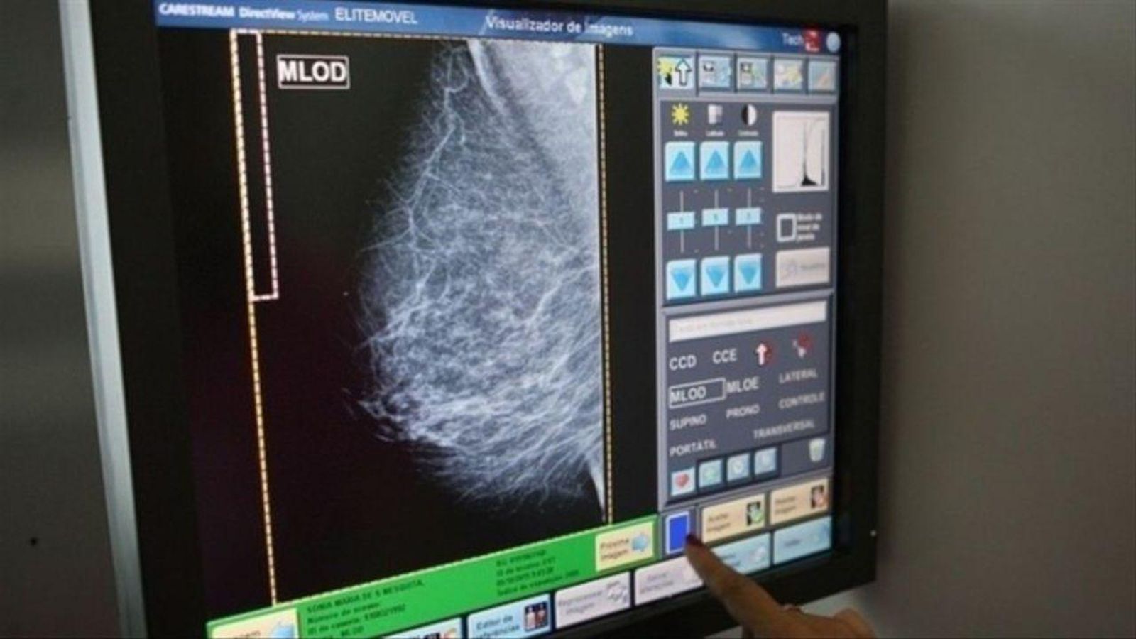 Una radiografia d'una pacient amb càncer de mama 19.10.2021 | Ciència: investigació sobre el càncer de mama.