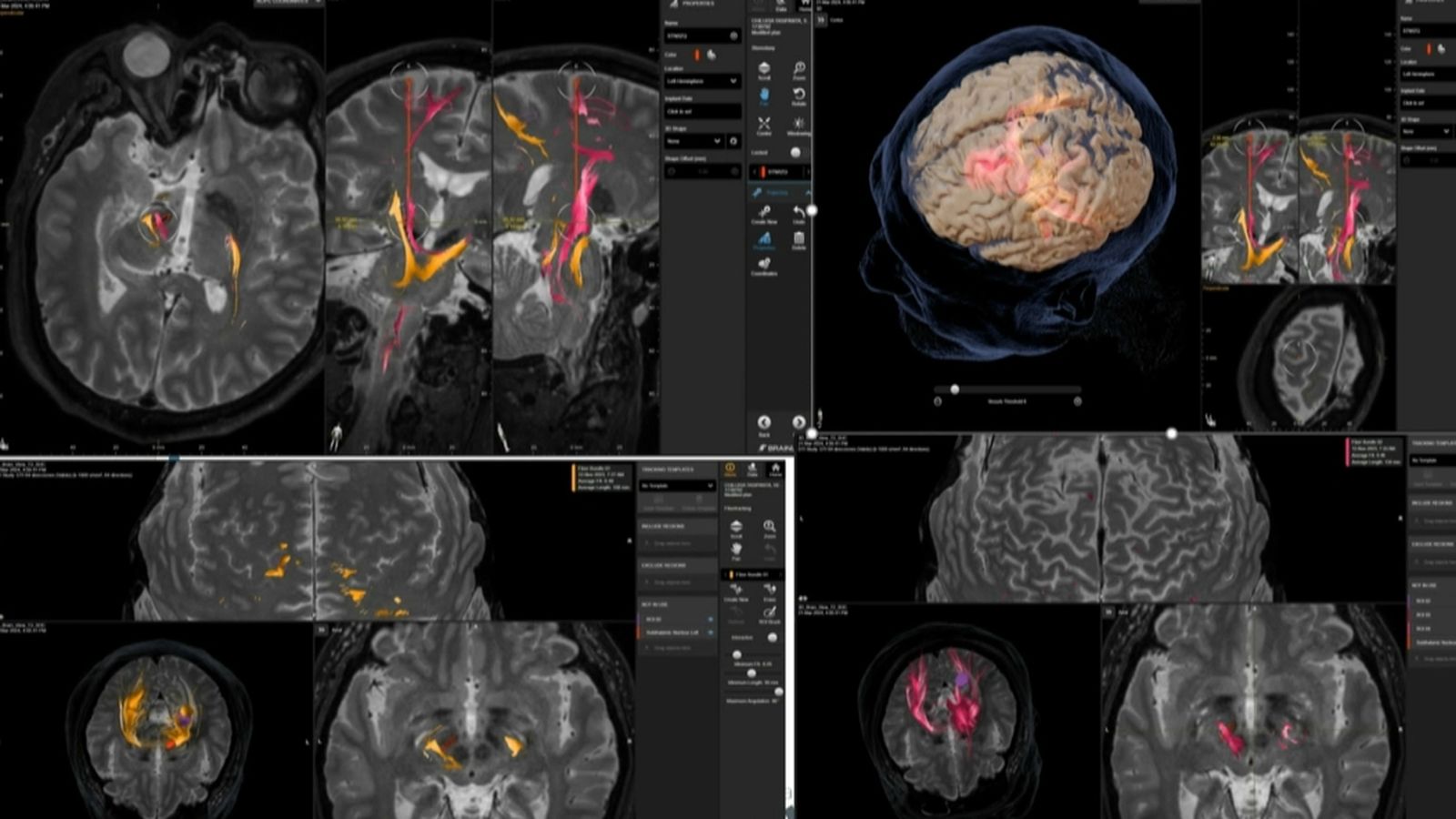 Millores en el diagnòstic de Parkinson